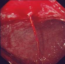 Gut Bleeding
